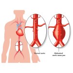 Tratamento Endovascular de Aneurisma